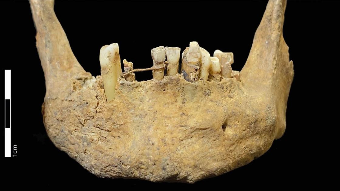  500-year-old gold dental bridge is earliest known oral care of its kind in Scotland — and it likely held a fake tooth 