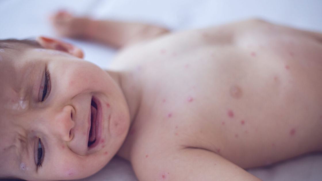 Pennsylvania issues alert on congenital measles—something US hasn't seen for decades