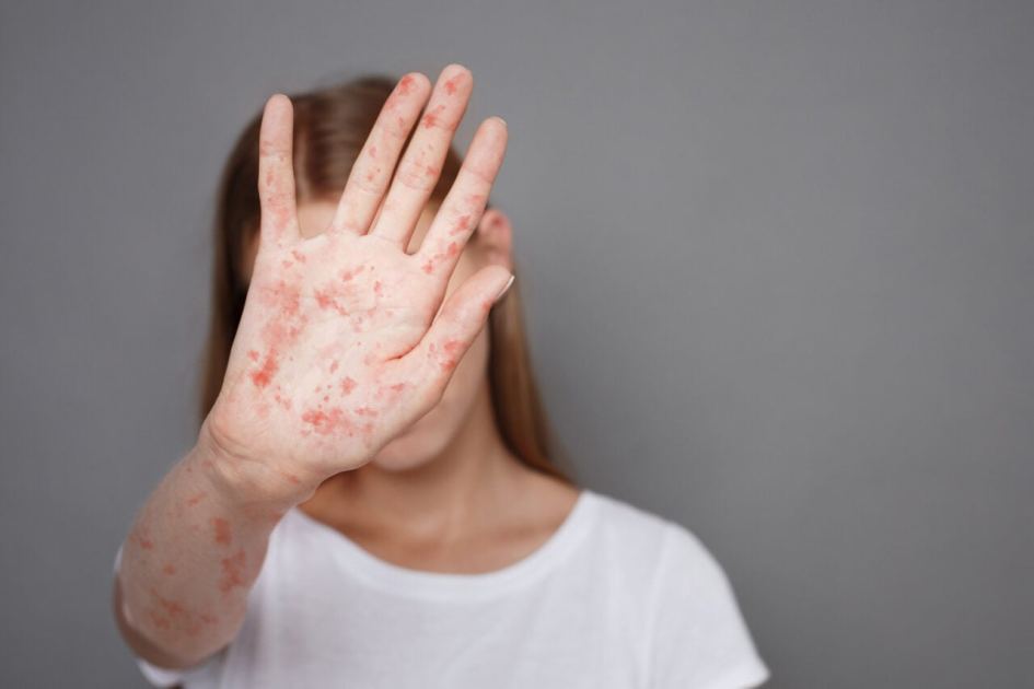Pennsylvania Officials Report Yet Another Death Linked to Measles as Outbreak Grows