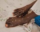 Mpox is back – and in new countries. How can this outbreak be contained?