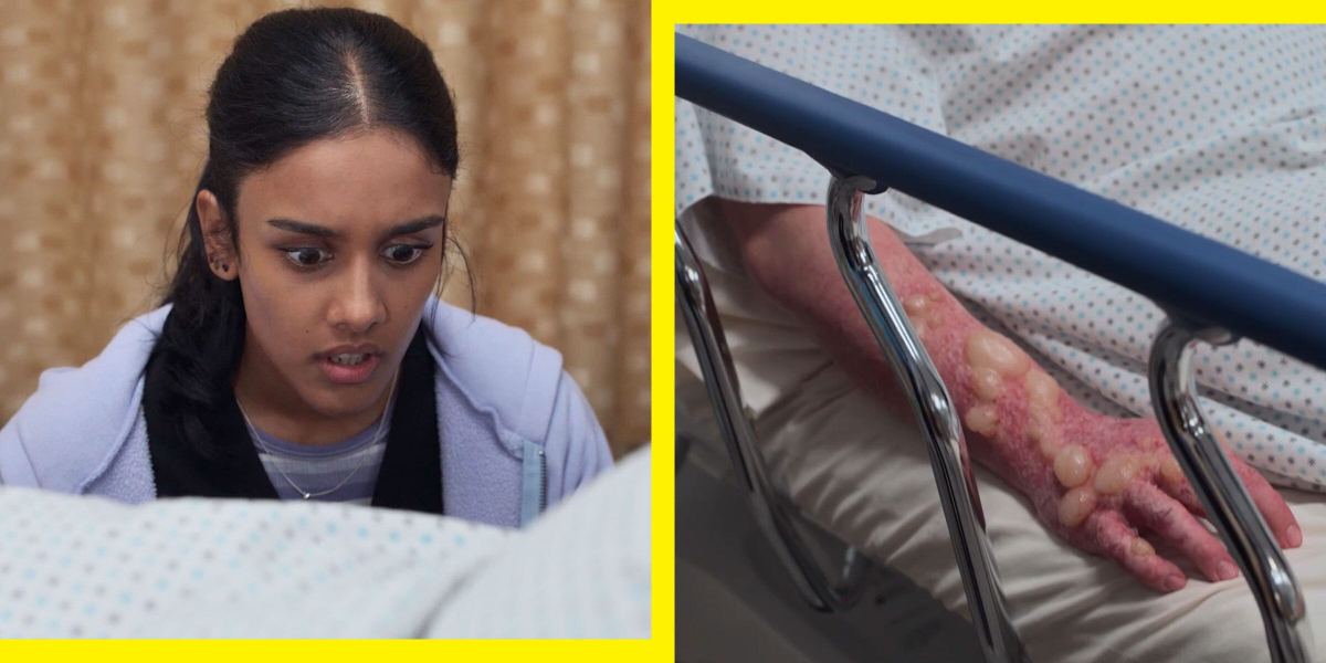 An ER Doctor Reacts to Those Gnarly Blisters in <em>The Pitt</em> Season 2, Episode 8