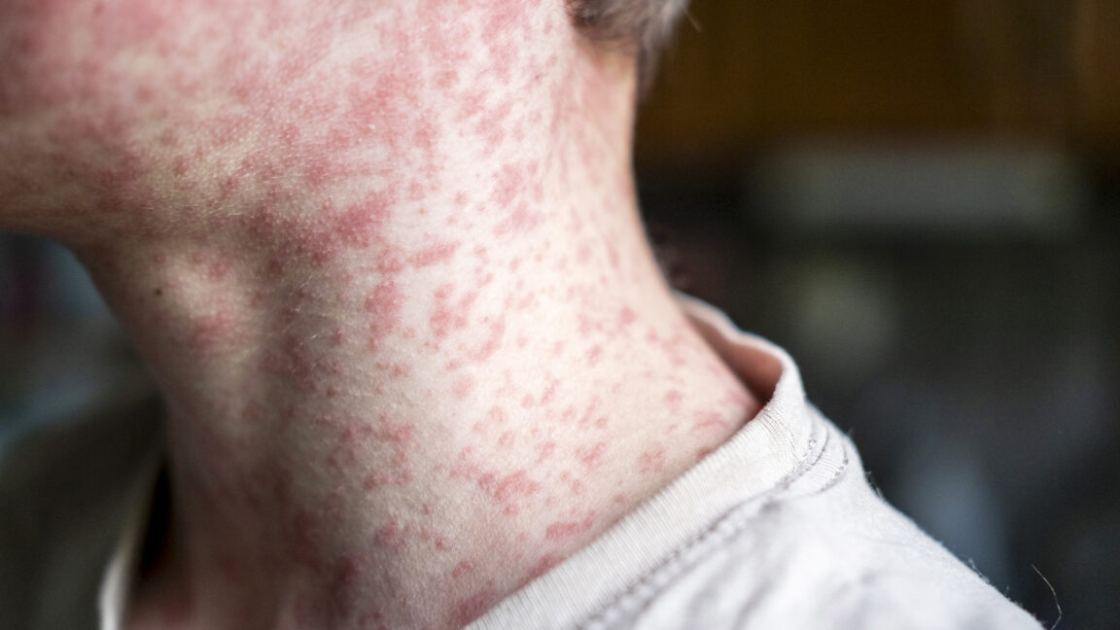 18-year-old dies of measles in PA from severe neurological complication