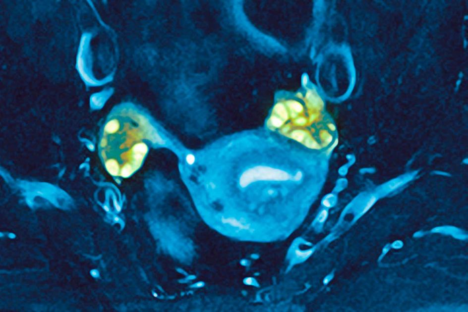 PCOS postpones perimenopause and allows pregnancies at older ages