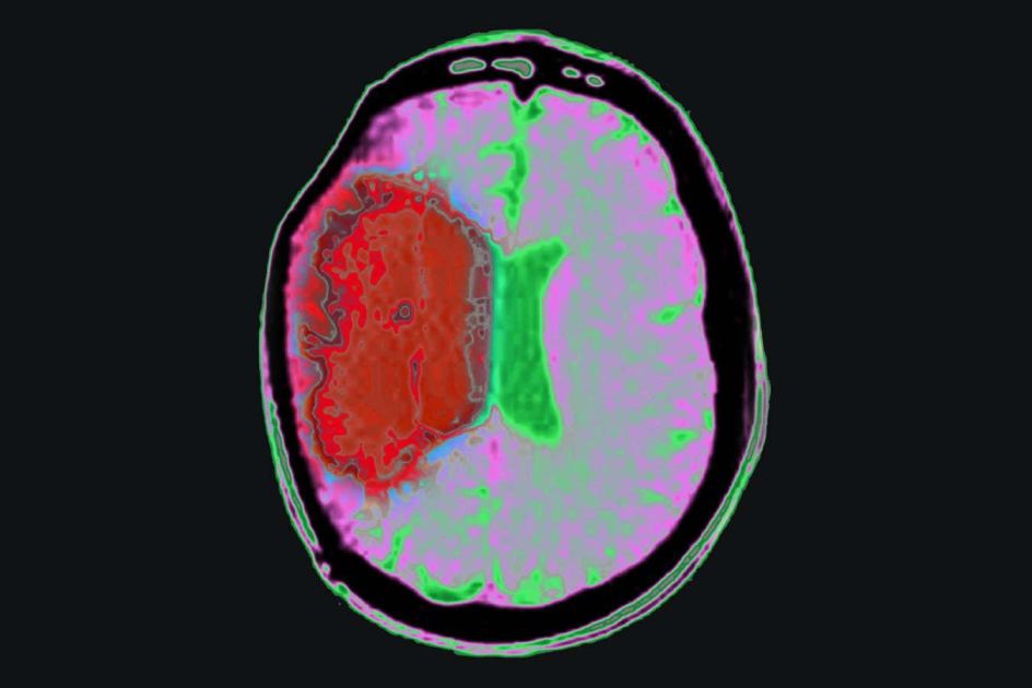 Chilling the body with drugs could limit brain damage from stroke