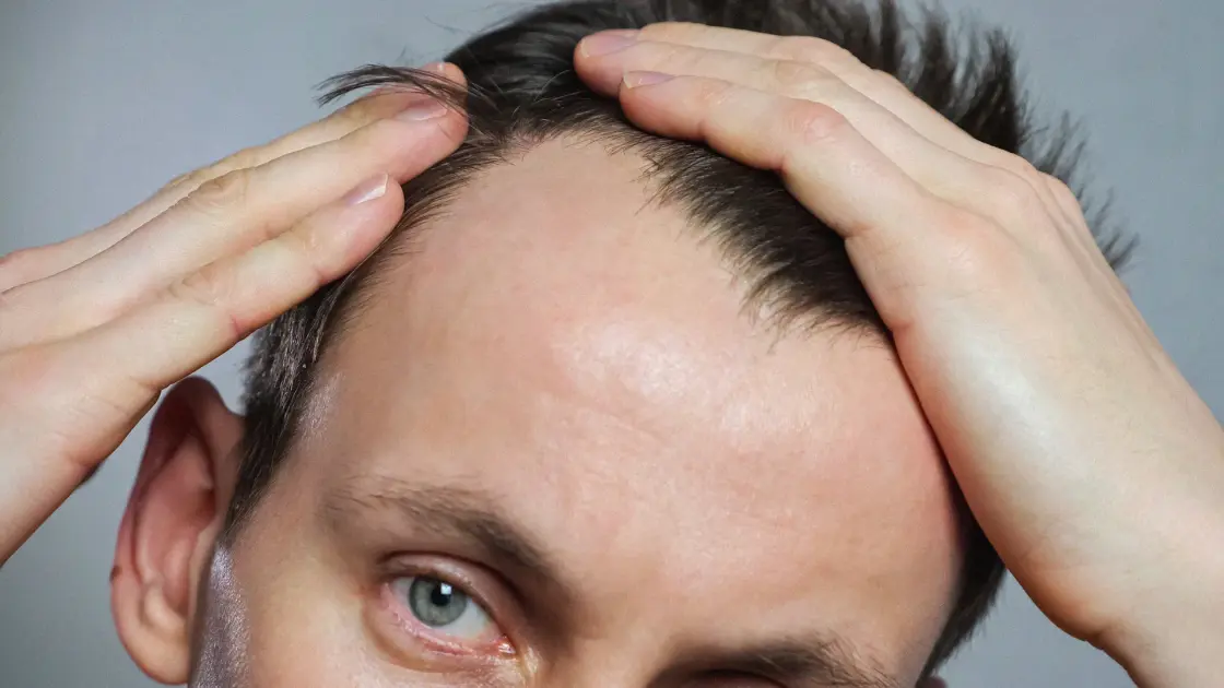 Could Doctors Predict Hair Loss Before Prescribing GLP-1 Drugs? Researchers See a Path