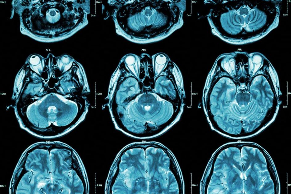 Autism may have two distinct subtypes that vary by brain activity