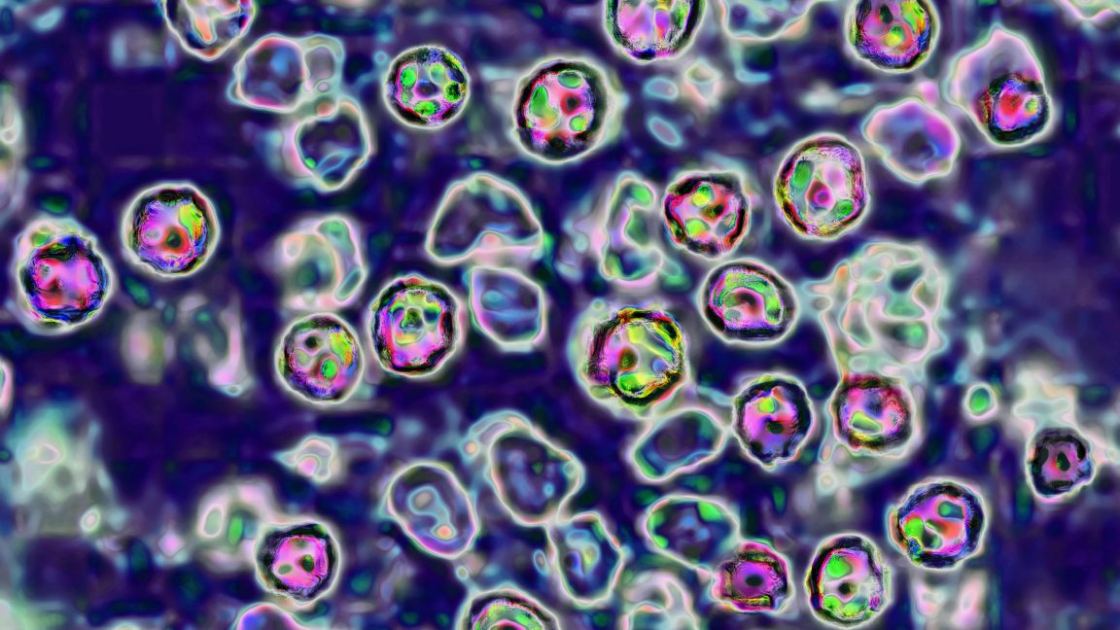Unvaccinated Pennsylvania woman died of measles complications, coroner says